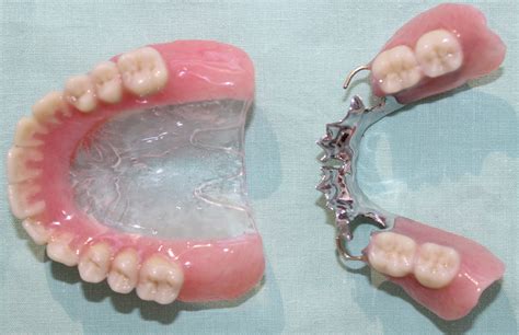 what is the metal housing denture|removable partial dentures.